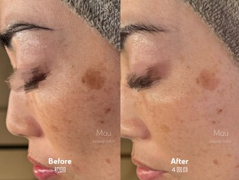 マウ(Mau)/シミケア