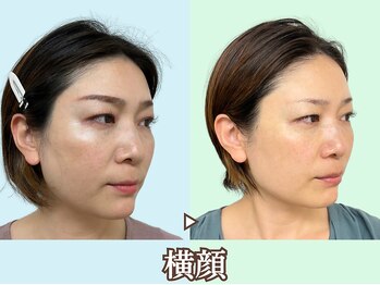 ナチュラルビューティーフェイス 横浜(NBF)/さりげない横顔美