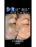 【人気No.1】 40代からの本格シミ改善プログラム 5名限定！￥31,800→￥13,200
