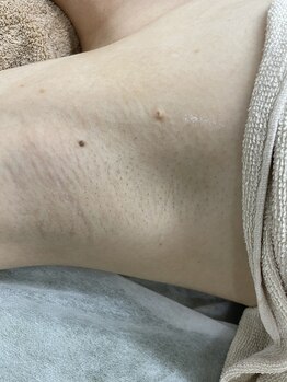 ナノハナ/鹿沼市の全身脱毛のナノハナ