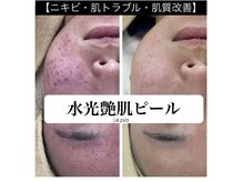レピア(Le'pia)の雰囲気（韓国本場のムルトクス人気！ニキビケア/肌質改善/水光艶肌）