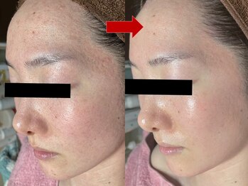 ブリリアン デイスパ 阪急西宮ガーデンズ店(BRILLIAN DAYSPA)/水光ピーリング