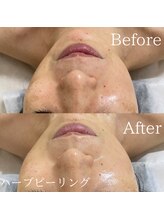 TD 清洲店/ハーブピーリング