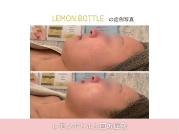 アメリイ 百合ヶ丘 新百合ヶ丘(Amerii)/【レモンボトル】1回の結果