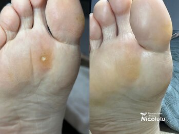 ポドロ ウィズ ニコルル 大阪天満店(PoDoLo with Nicolulu)の写真/専用の機械で時短＆痛みを最小限に。角質・魚の目をケアし、肩こりや腰痛の改善にも効果的