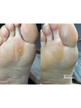 角質ケアができるサロン