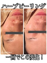 ル ミュー(le mieux)/剥離しないハーブピーリング