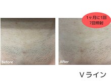 【脱毛・よもぎ蒸しサロン】Quokka/Vライン脱毛