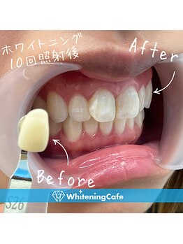 歯のホワイトニングWhiteningCafe六本木店【ホワイトニングカフェ】/ホワイトニング施術写真