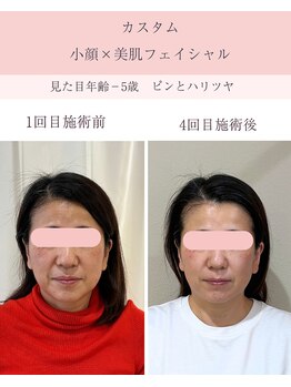 シンナリ(Shinnari)/カスタム小顔×美肌フェイシャル