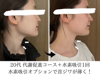 ヨサパーク タキ 上野毛(YOSA PARK TAKI)/20代・代謝促進＋水素吸引1回