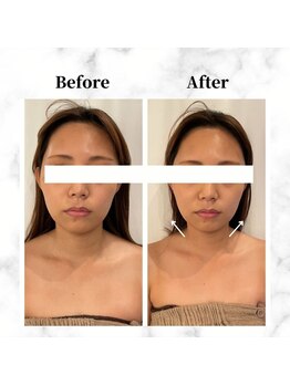 ザビューティー 麻布十番本店(The Beauty)/12Dリフト全顔打ち放題[リフト]