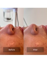 天使の艶肌 武蔵小杉店/ハーブ毛穴ケア before /after 2