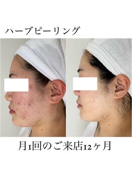 イム(I'm.)/ハーブピーリング before/after