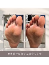 ネイルエキスパートプラス(ネイルエキスパート+)/たこ　ウオノメ　取り放題