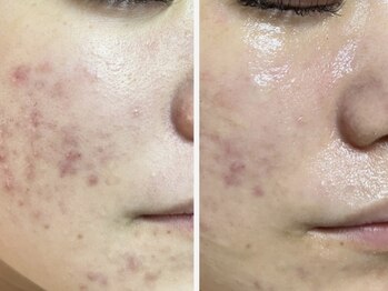 ドゥナ(DUNA)/7日間肌質改善