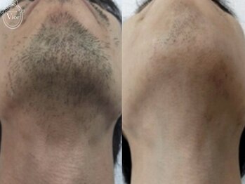 ヴィオール 名古屋栄店(VIOR)/【メンズ脱毛】 ひげ