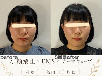 エスポワール(espoir)の写真/【エステ版オンダ最高峰】サーマウェーブ×EMS×小顔矯正で最短Vラインができる持続型小顔リフト〈7800円〉