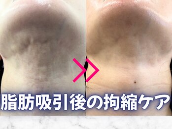 パッパ(PAPPA)/アゴ裏ボコボコに｜衝撃波/小顔