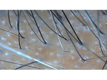 プリマプリート メンズ店/《毛の成長促進》栄養成分導入!!