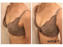 リール 新宿店(RIRE)/30代前半　バストアップ症例
