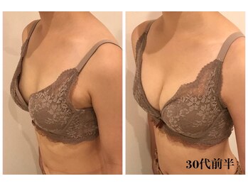 リール 新宿店(RIRE)/30代前半 バストアップ症例