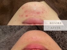 レヴィア(Revia)/ハーブピーリングで顎ニキビケア