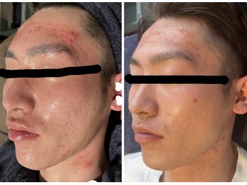 ビーアンドアイ シズオカテン メンズ(B＆I SHIZUOKA)/繰り返しニキビでお悩みの方