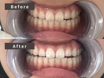 ピーチ(Peach)/セルフホワイトニング