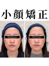 キュープ 相模原淵野辺店(Qpu)/たった4回で人生で1番小さな顔に