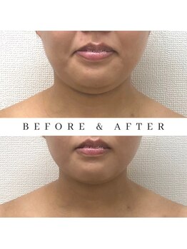 ルルド(Lourdes)/顔を触らず顔のリフトUP