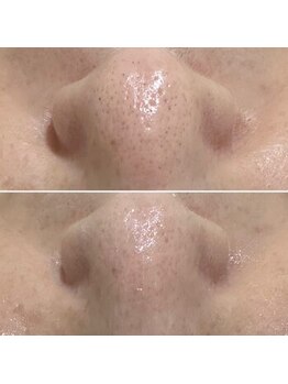 ハーナウ ハウ(hanau hou)/ハーブピーリング効果