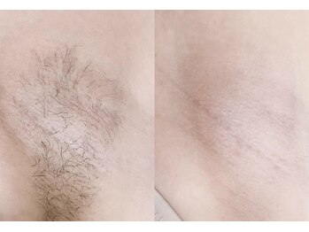 ヴィテラス バイ アリア(Veteras by aria)/☆最短回数で脱毛完了が叶う☆