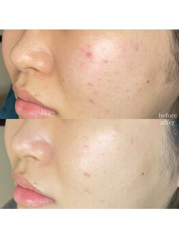 ちらちゅら/クリスティーナ【施術3回】