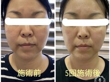 マーガレット整体/微弱電流フェイシャルの施術前後