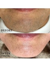 エース(ACE.)/青ヒゲ解消！清潔感アップ☆