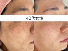 サクラ 本厚木駅前店(SAKURA)/本厚木シミケア/伊勢店シミケア