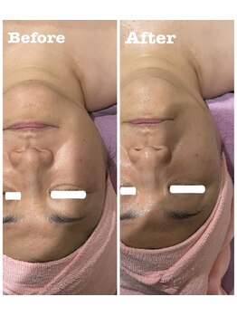 カスミソウ/光フェイシャルで小顔効果