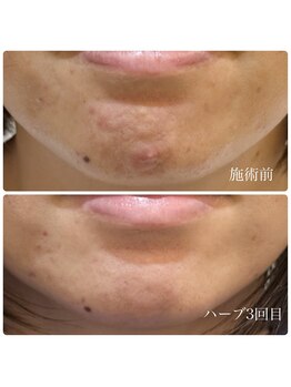 チョチョワンプラス(緒々one+)/繰り返すニキビにオススメ