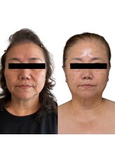 リノン(LIINON)/未来の美しさは、今の決断から。