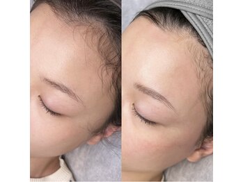 ポアラ(POARA)/毛穴/ワックス脱毛