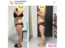 エミニナル(emininal)/フォースカッター　40代　３回