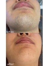 シャイン 熊本店(SHINE)/髭脱毛ビフォーアフター♪