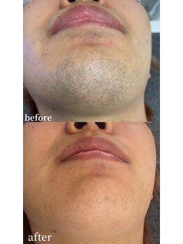 シャイン 熊本店(SHINE)/髭脱毛ビフォーアフター♪