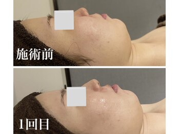 ザモア 福岡天神(THE MORE)/ララピールでうるツヤ水光肌