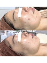 ヴィノ アイサロン(VINNO eyesalon)/ハーブピーリングでお悩み撲滅！