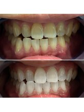 エピシアドットエヌ(epicia.N)/サロンで白い歯になれる！