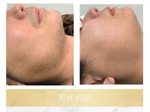 アンド エヌ(&n)/◆髭脱毛◆