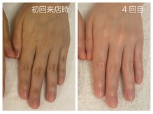 キレイテ 福岡天神店/40代/4回目【福岡ハンドケア】