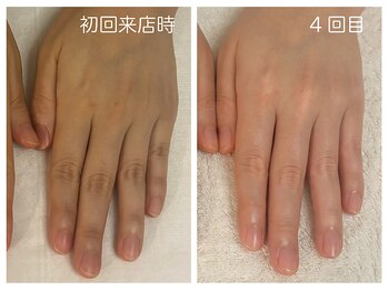 キレイテ 福岡天神店/40代/4回目【福岡ハンドケア】